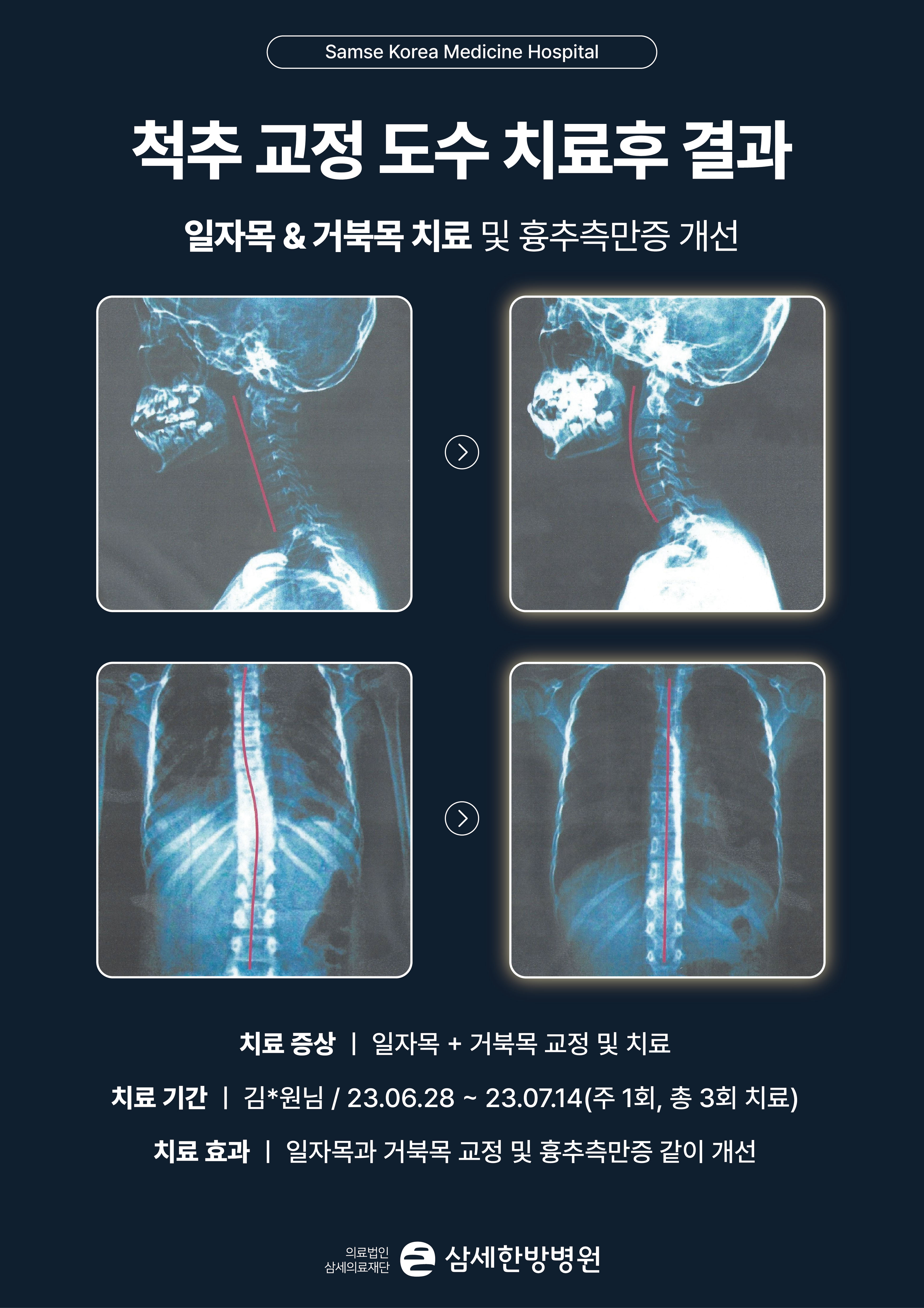 비포애프터(2)